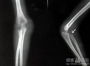 骨折病人可以吃蛇瓜,天然食材助力骨骼健康